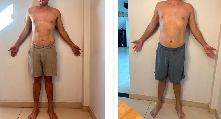 Antes e depois de paciente — Dr. Sérgio Daniel