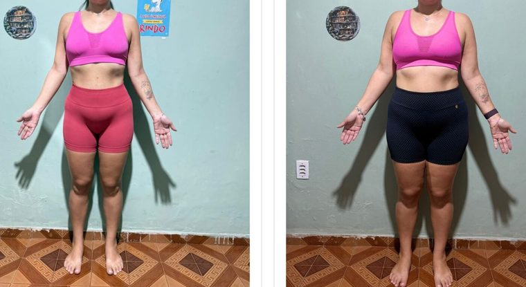 Antes e depois de paciente — Dr. Sérgio Daniel