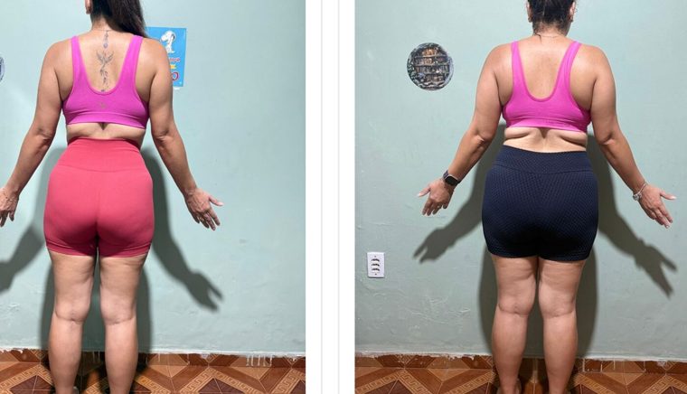 Antes e depois de paciente — Dr. Sérgio Daniel