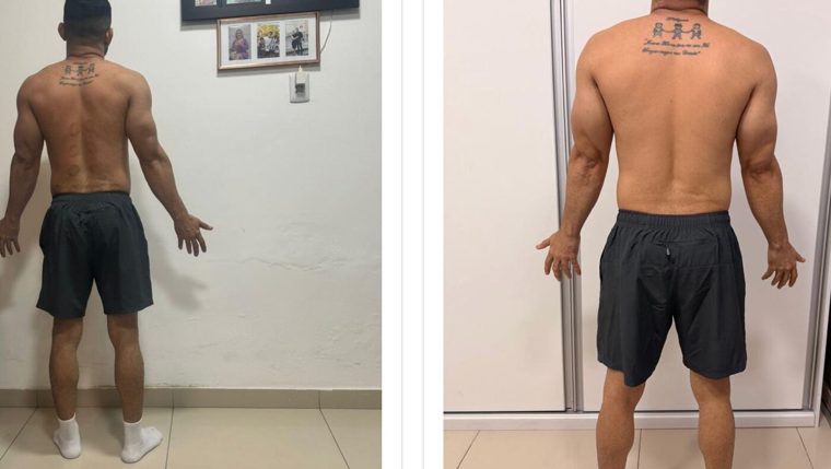 Antes e depois de paciente — Dr. Sérgio Daniel